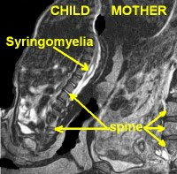 Scan of mother and 2-year old child with Syringomyelia, a disorder in which a cyst forms within the spinal cord.