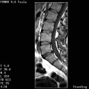 The Stand-Up MRI Imaging Capabilities for the Lumbar.